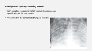 Homogeneous Opacity Obscuring Vessels
• With complete replacement of alveolar air, homogeneous
opacification of the lung results.
• Vessels within the consolidated lung are invisible
 