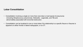 Lobar Consolidation
• Consolidation involving a single (or more than one) lobe is most typical of pneumonia
(including Streptococcus pneumoniae, Klebsiella , Legionella, and TB) and
abnormalities associated with bronchial obstruction.
• Consolidation can be localized to one or more lobes if its relationship to a specific fissure or fissures is
apparent on either frontal or lateral radiographs, or on CT.
 