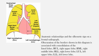 Pathologies of the airspace disease.pptx
