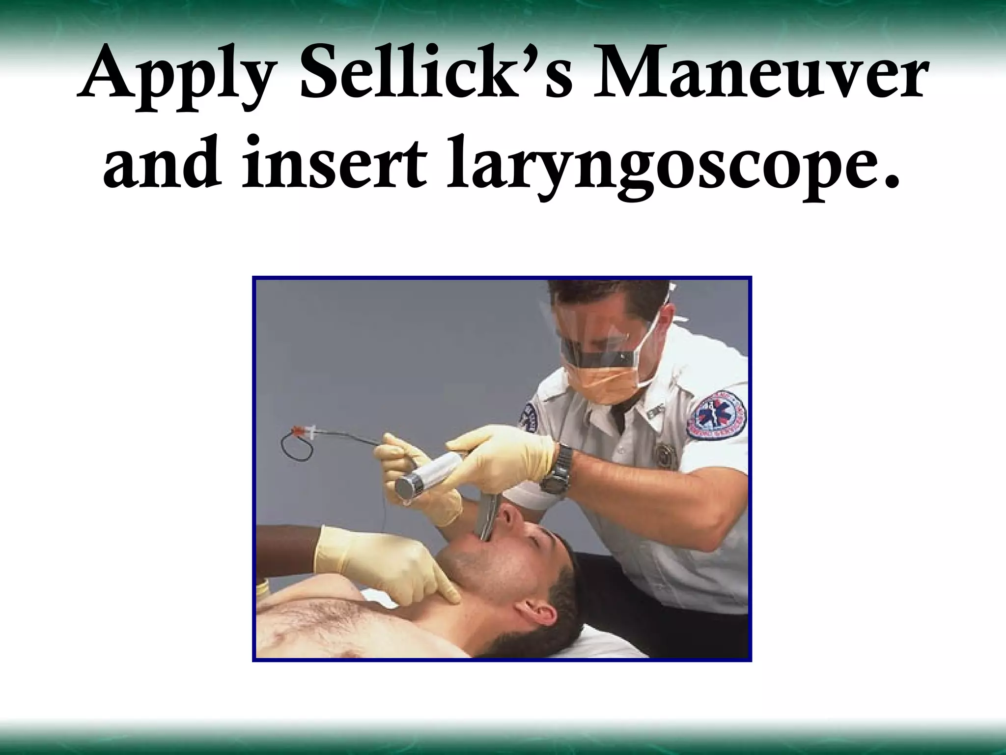 Apply Sellick’s Maneuver
and insert laryngoscope.
 