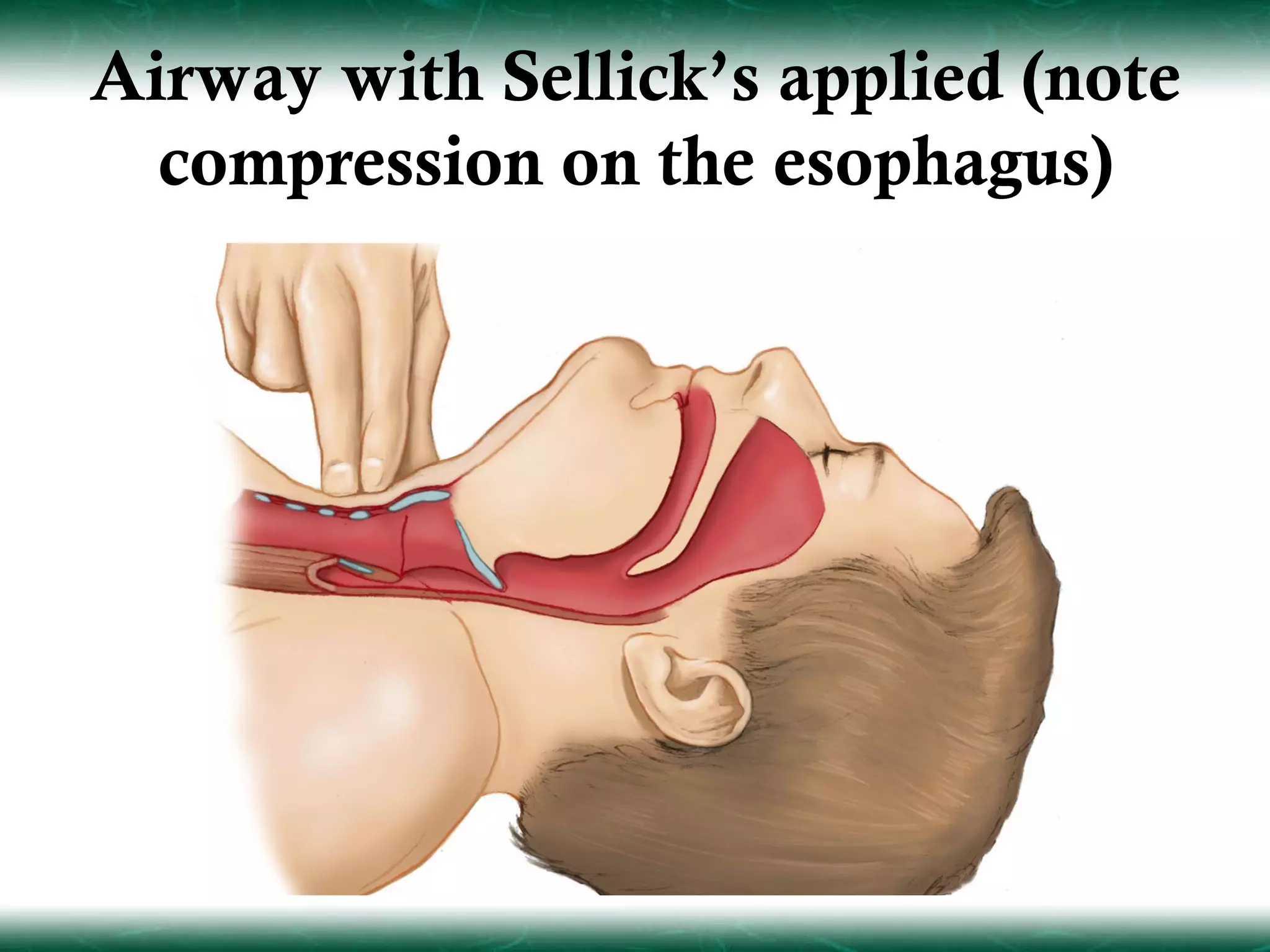 Airway with Sellick’s applied (note
  compression on the esophagus)
 