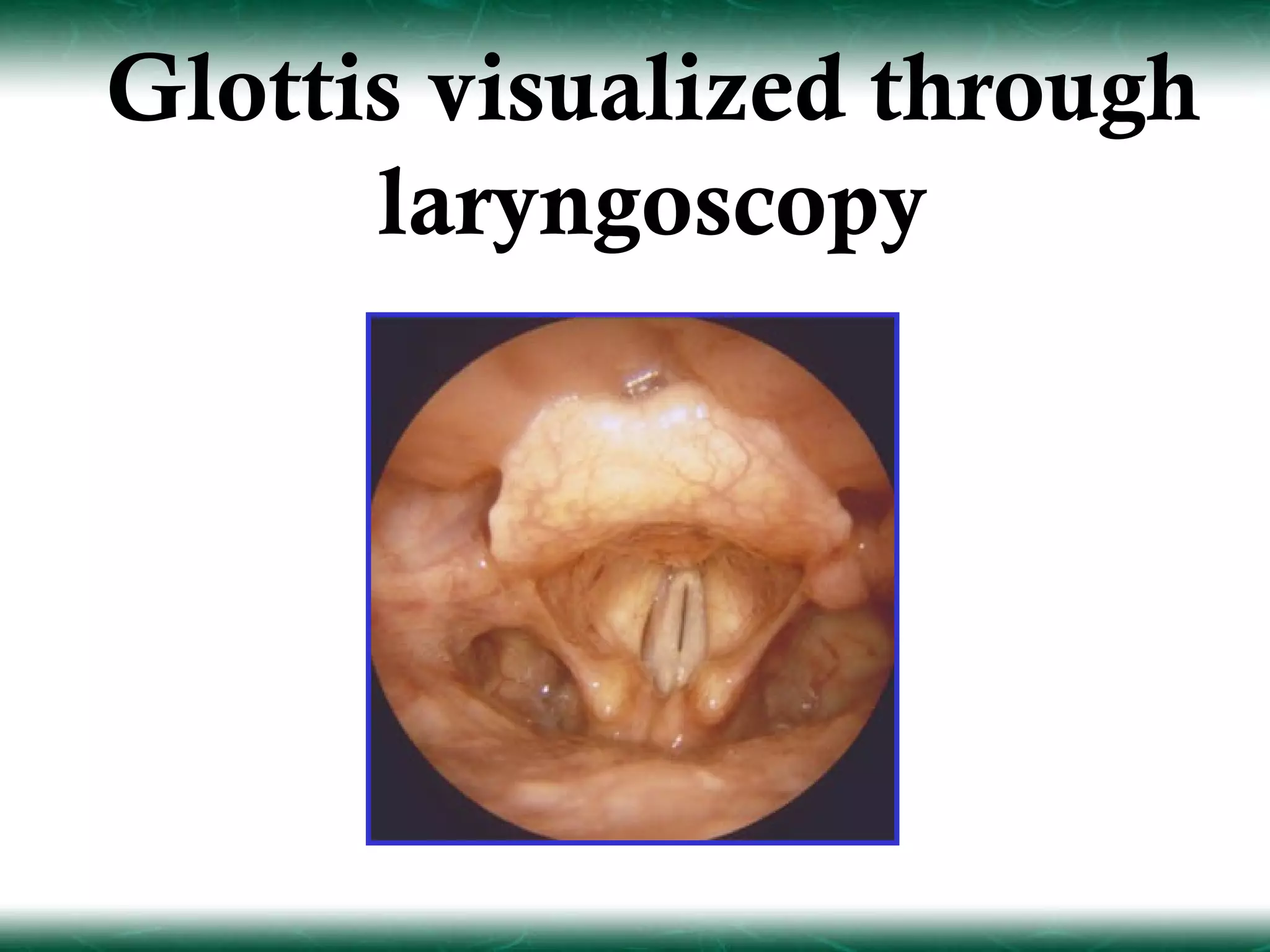 Glottis visualized through
      laryngoscopy
 