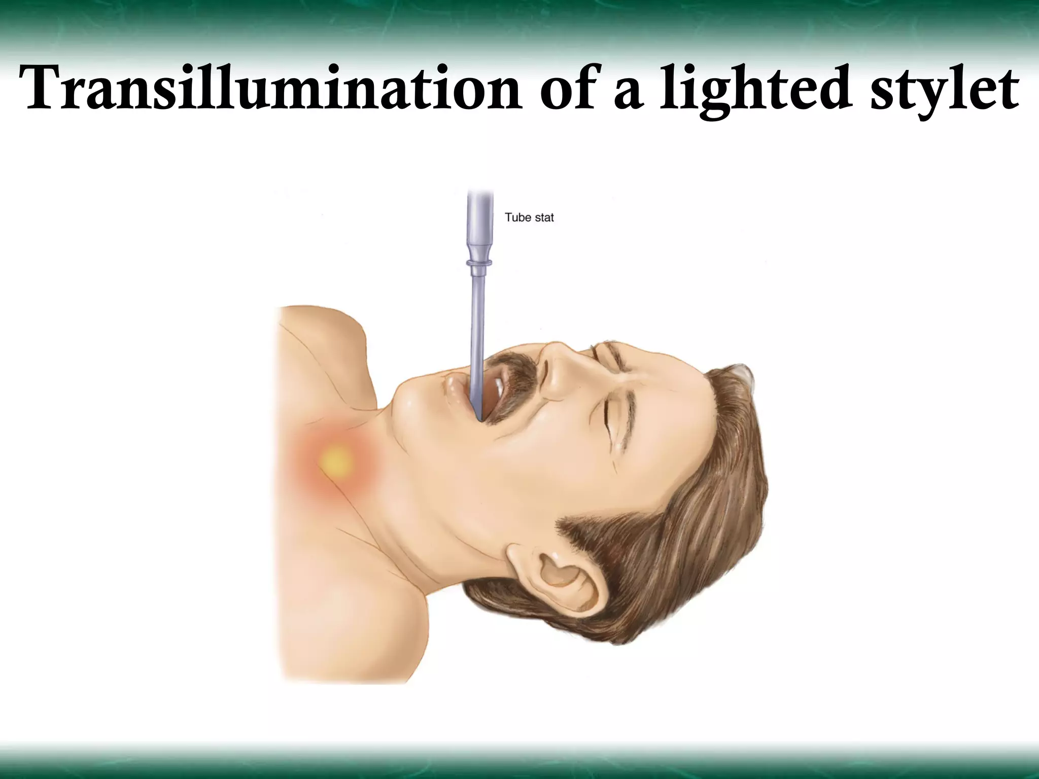 Transillumination of a lighted stylet
 