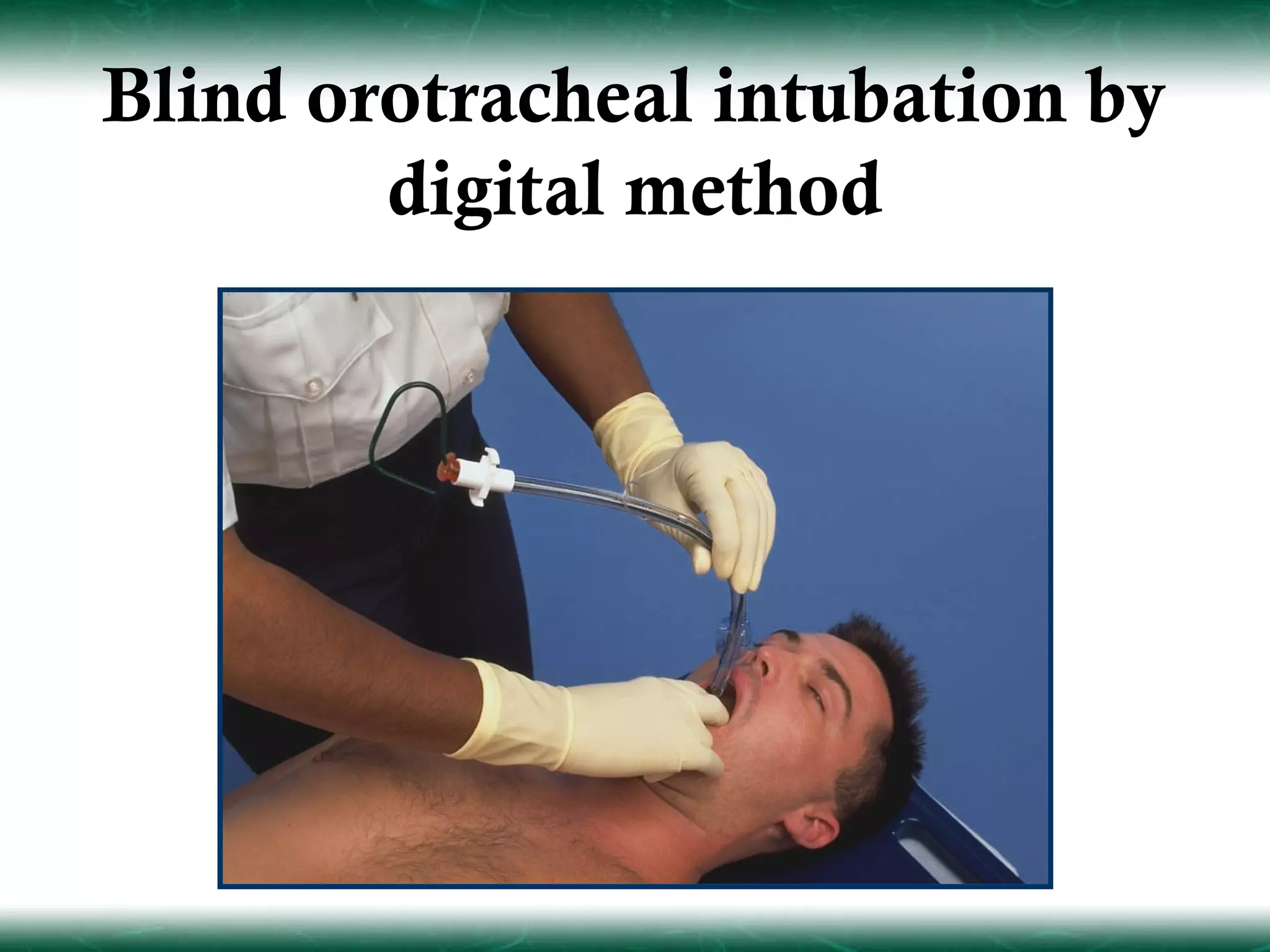 Blind orotracheal intubation by
        digital method
 