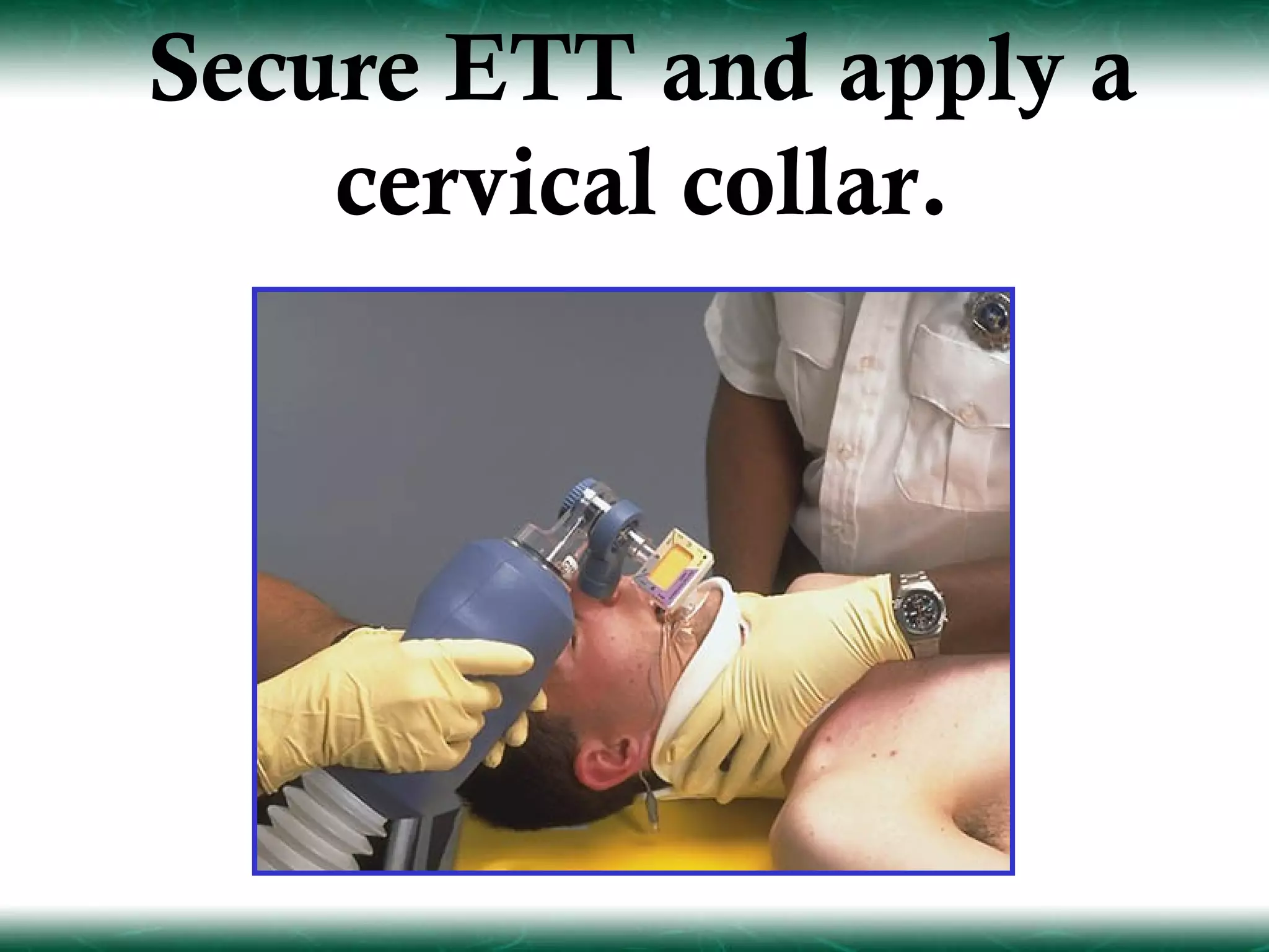 Secure ETT and apply a
    cervical collar.
 