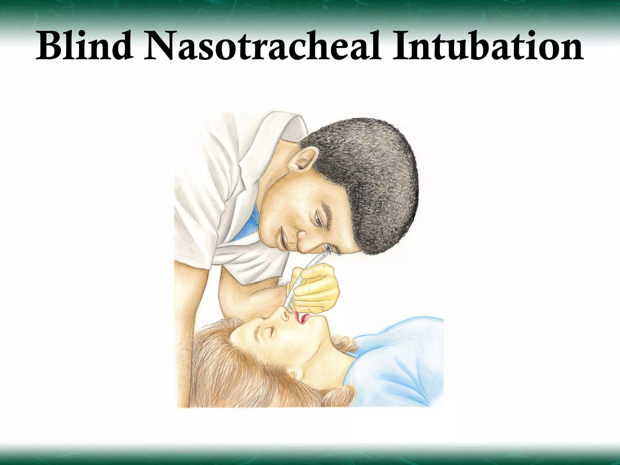 Blind Nasotracheal Intubation
 