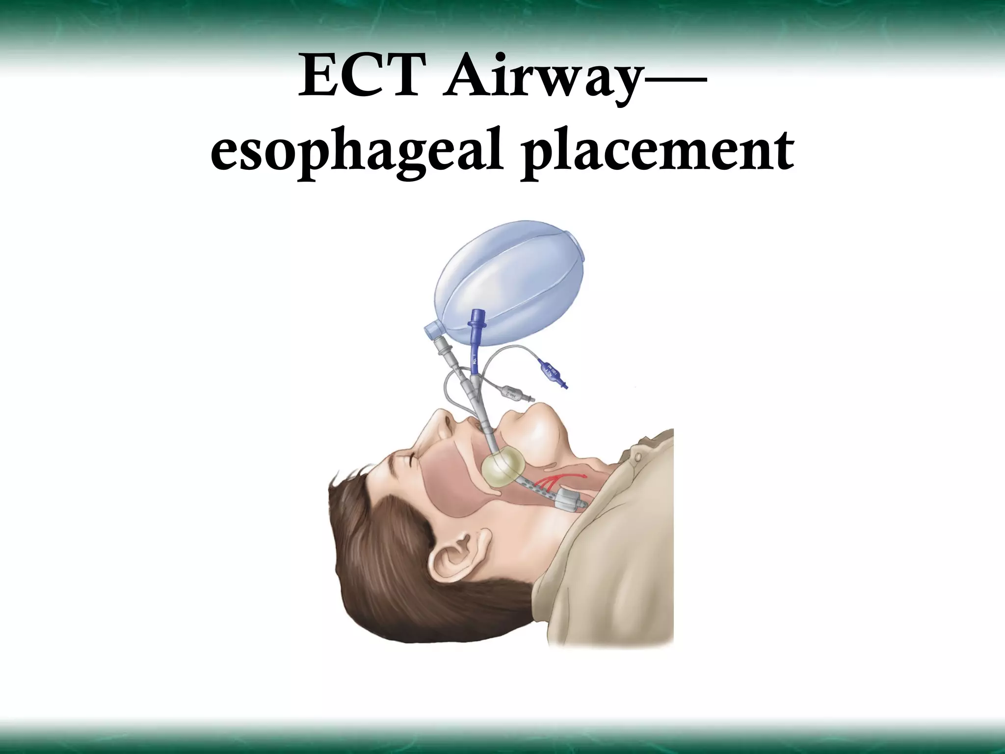 ECT Airway—
esophageal placement
 