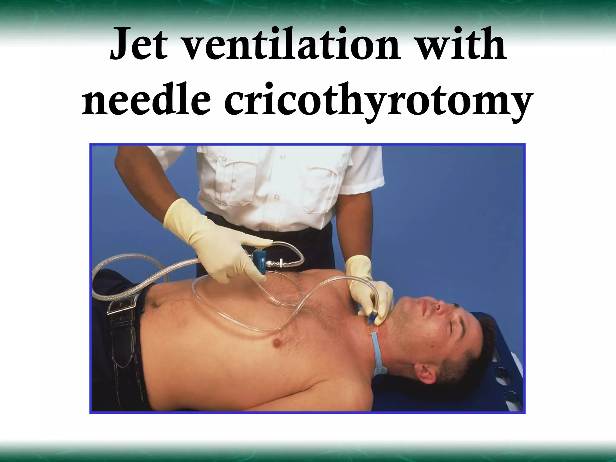 Jet ventilation with
needle cricothyrotomy
 
