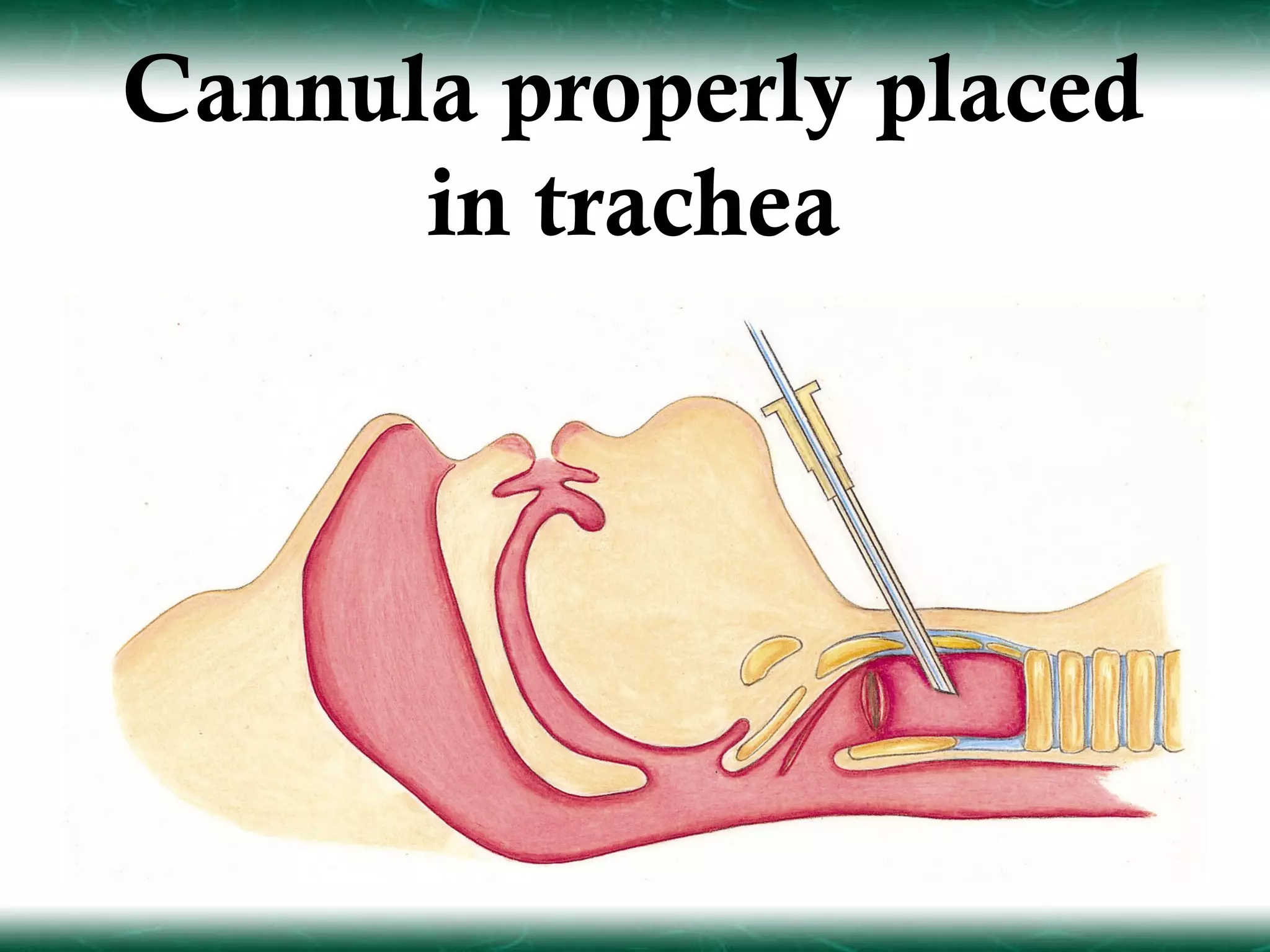 Cannula properly placed
      in trachea
 