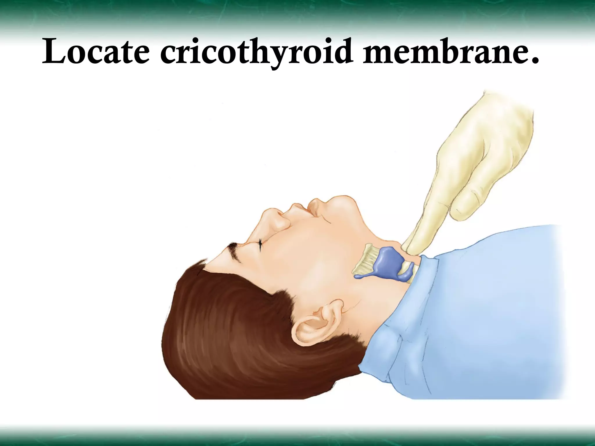 Locate cricothyroid membrane.
 