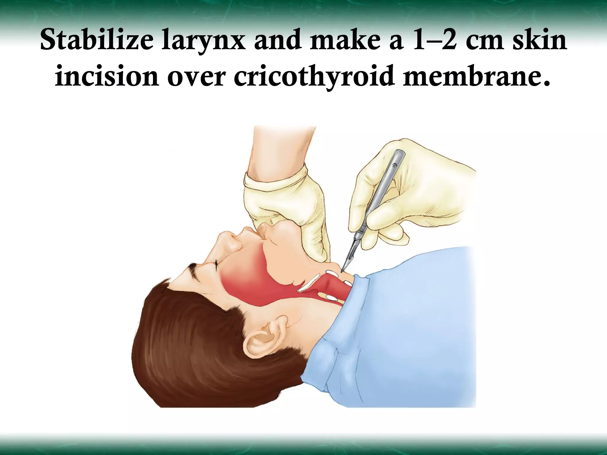 Stabilize larynx and make a 1–2 cm skin
 incision over cricothyroid membrane.
 