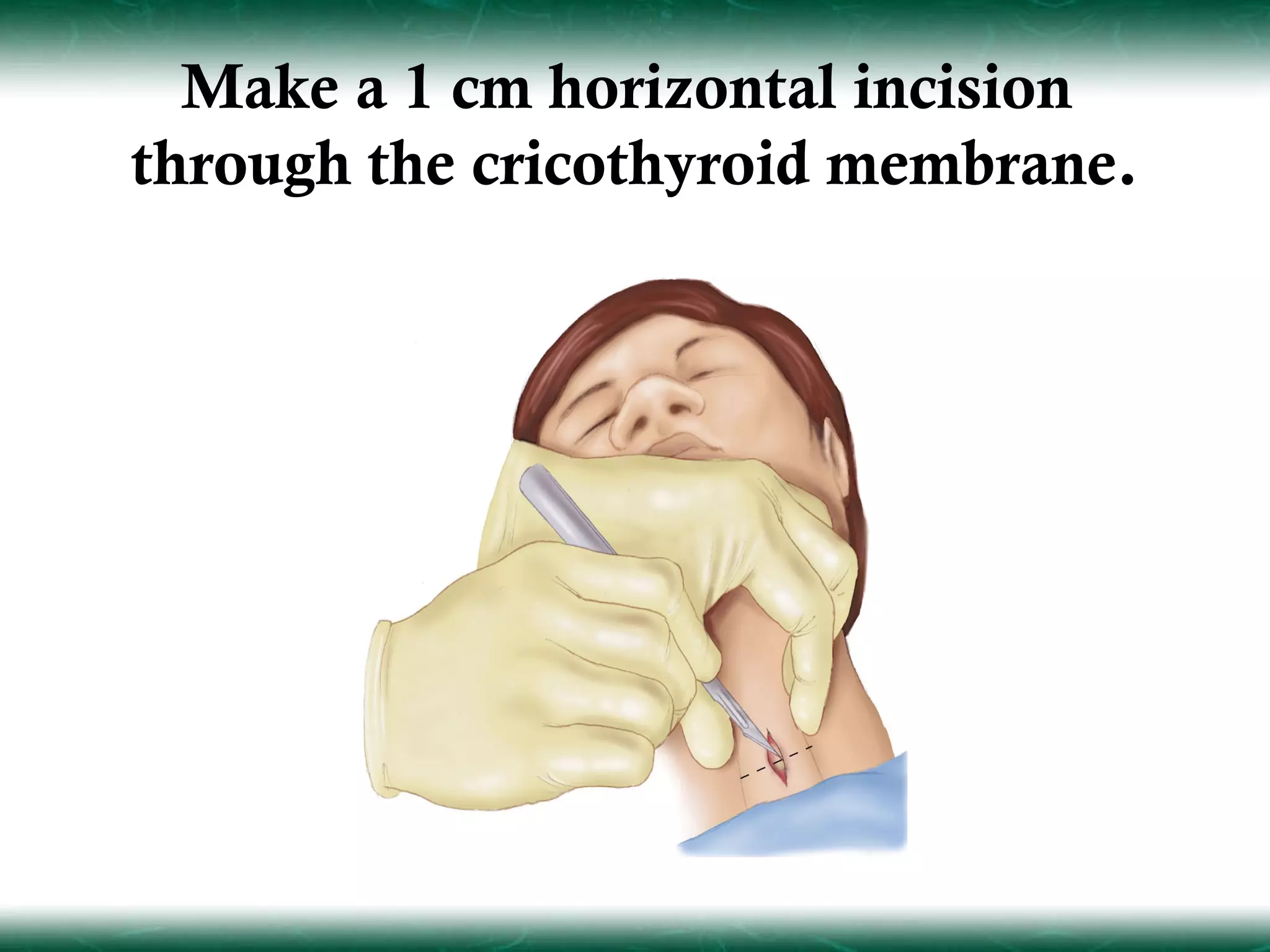 Make a 1 cm horizontal incision
through the cricothyroid membrane.
 