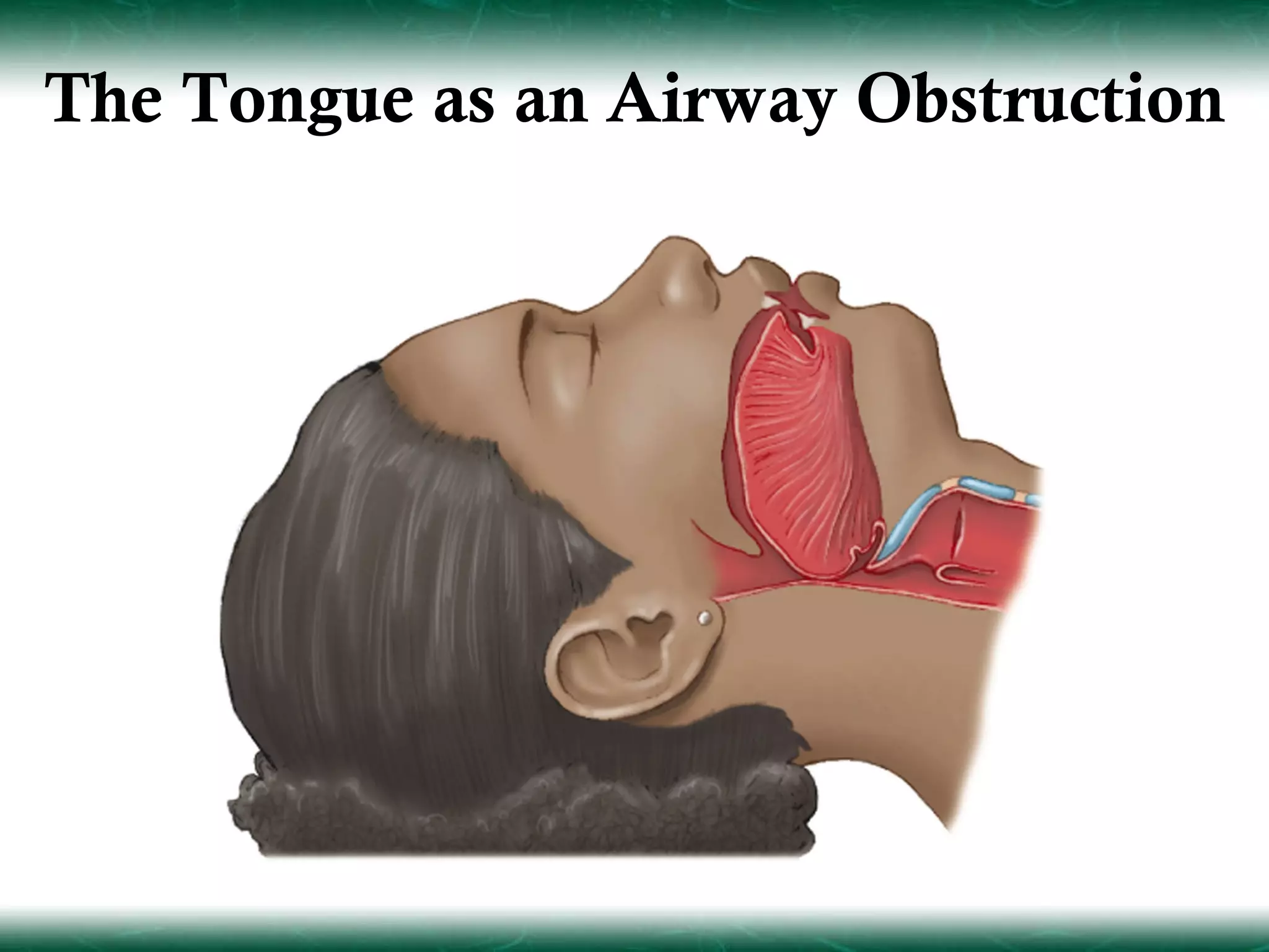 The Tongue as an Airway Obstruction
 