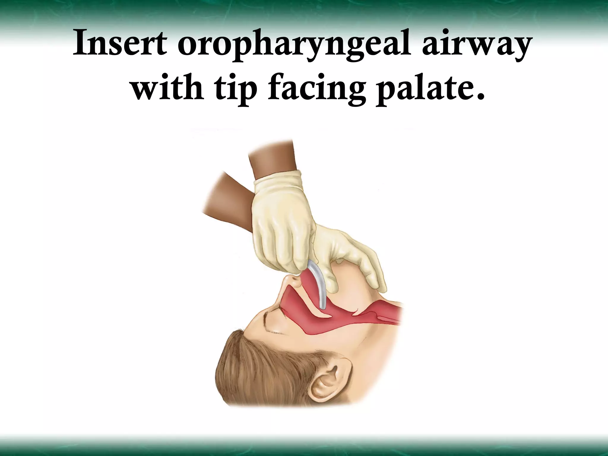 Insert oropharyngeal airway
   with tip facing palate.
 