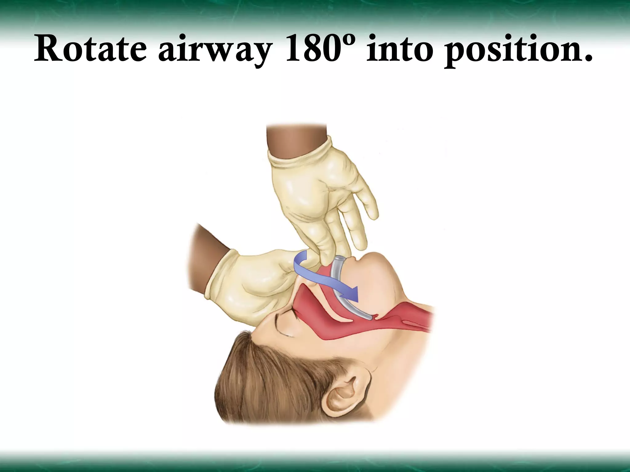 Rotate airway 180º into position.
 