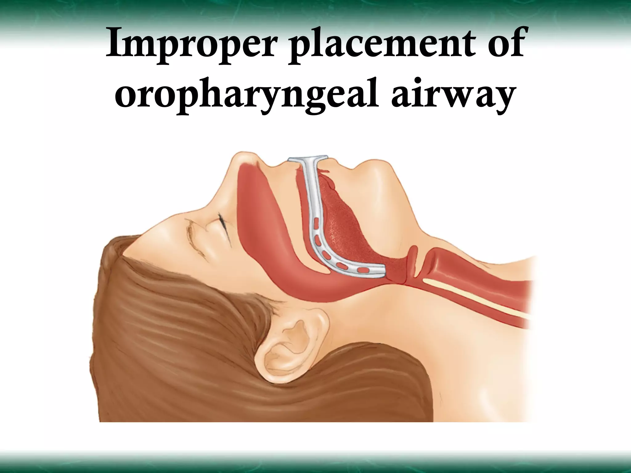 Improper placement of
 oropharyngeal airway
 