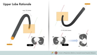 Upper Lobe Rationale
flipped default
 