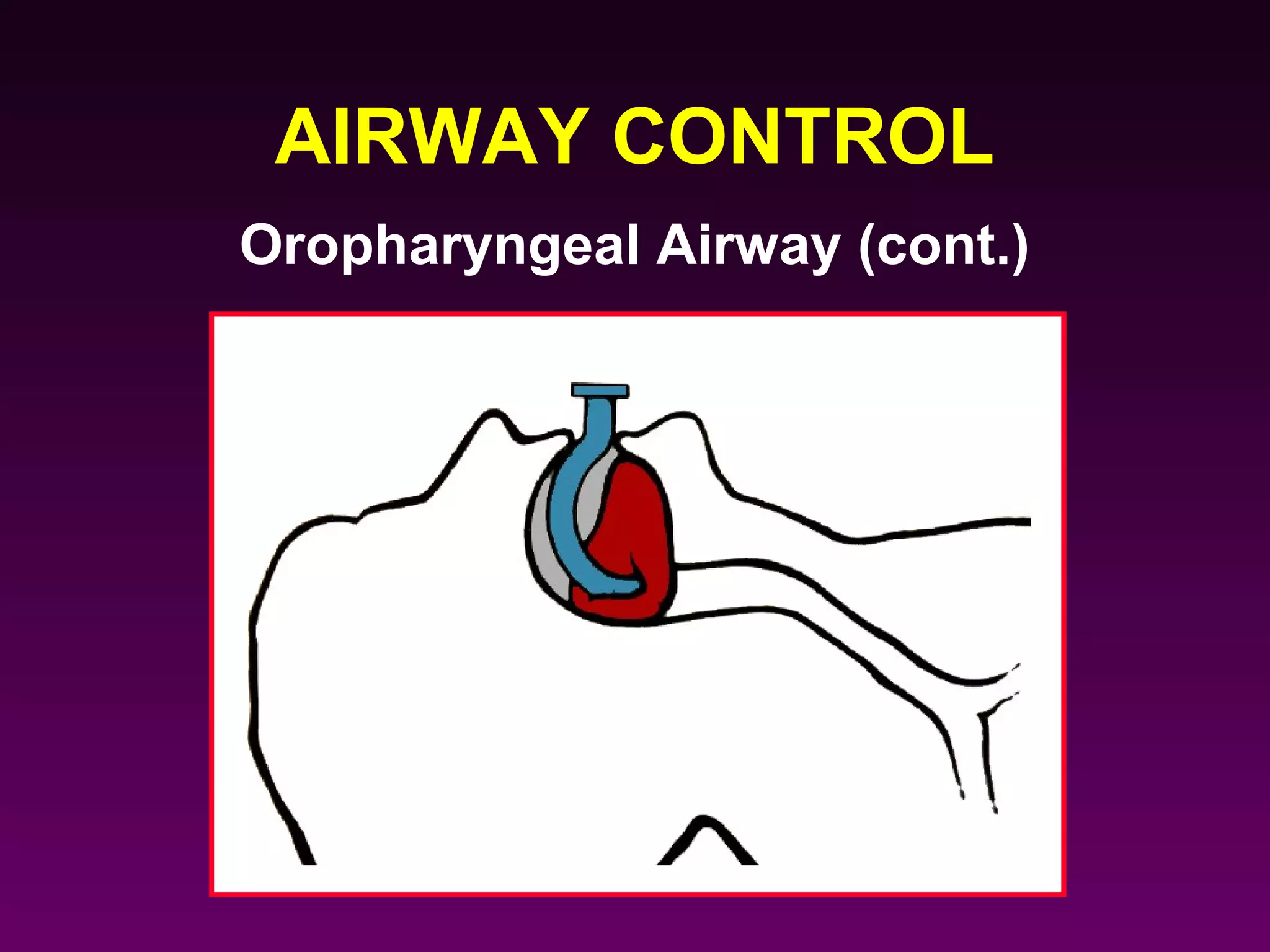 AIRWAY CONTROL
Oropharyngeal Airway (cont.)
 