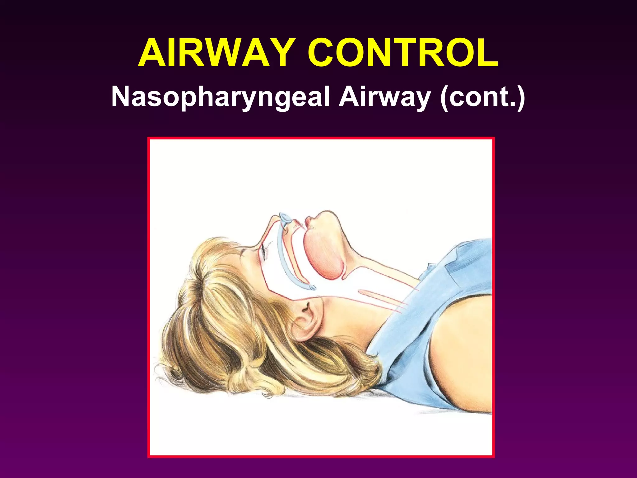 AIRWAY CONTROL
Nasopharyngeal Airway (cont.)
 