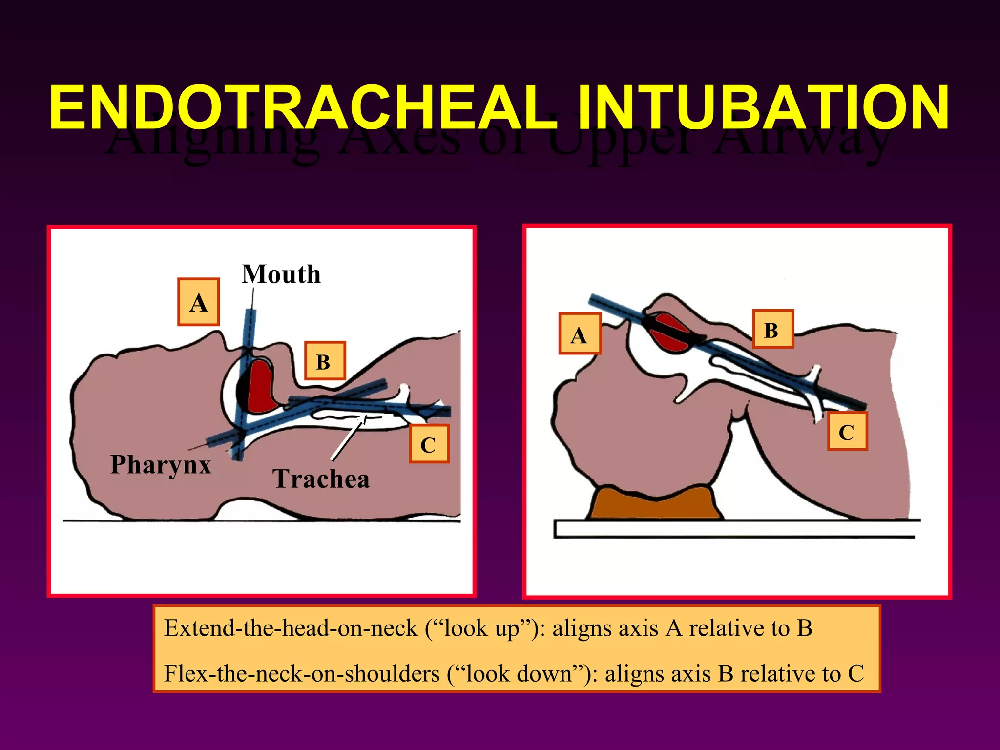 ENDOTRACHEAL INTUBATION
 Aligning Axes of Upper Airway

            Mouth
       A
                                             A                  B
                   B


                                                                        C
                              C
  Pharynx
               Trachea




     Extend-the-head-on-neck (“look up”): aligns axis A relative to B
     Flex-the-neck-on-shoulders (“look down”): aligns axis B relative to C
 