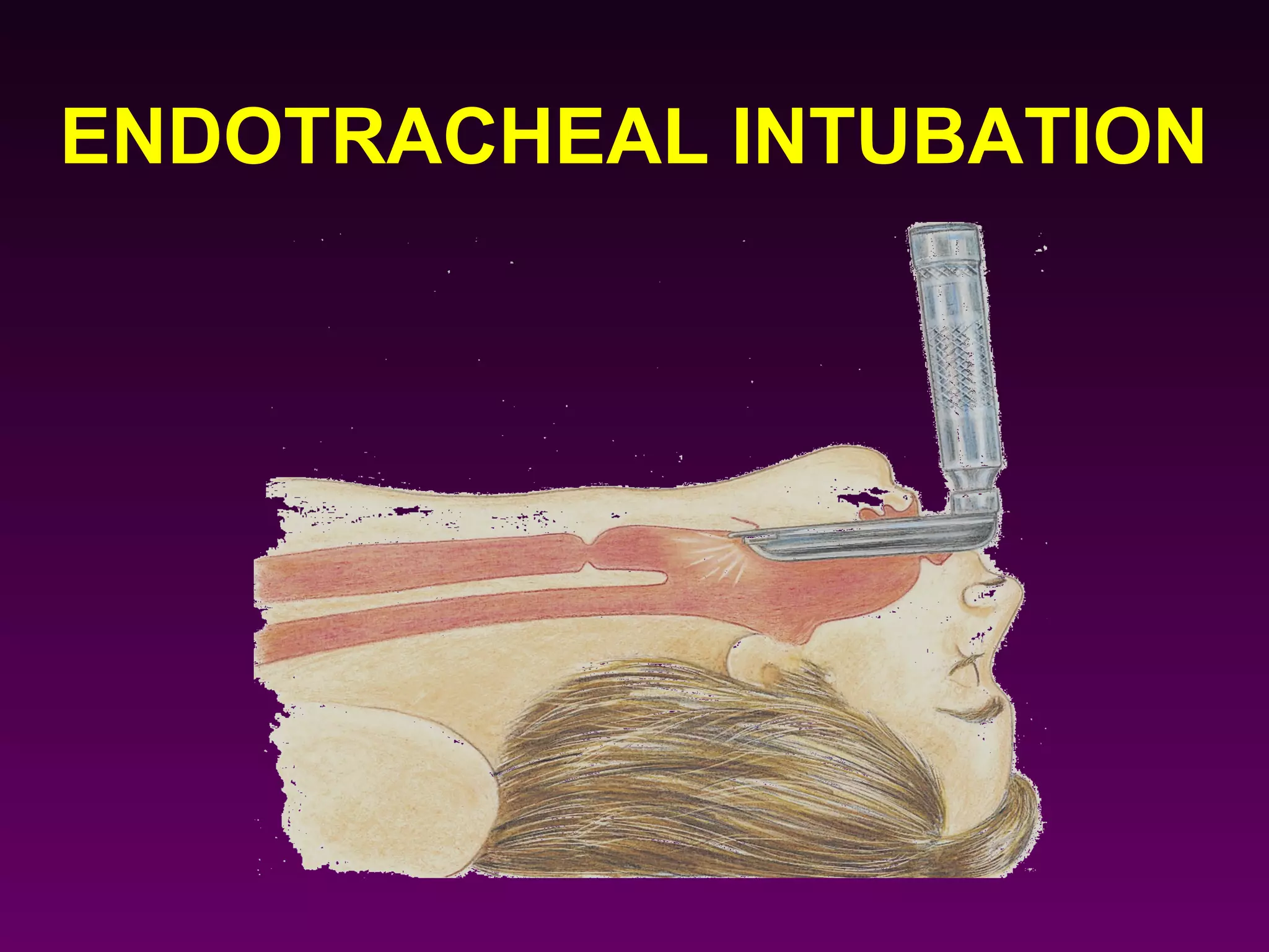 ENDOTRACHEAL INTUBATION
 