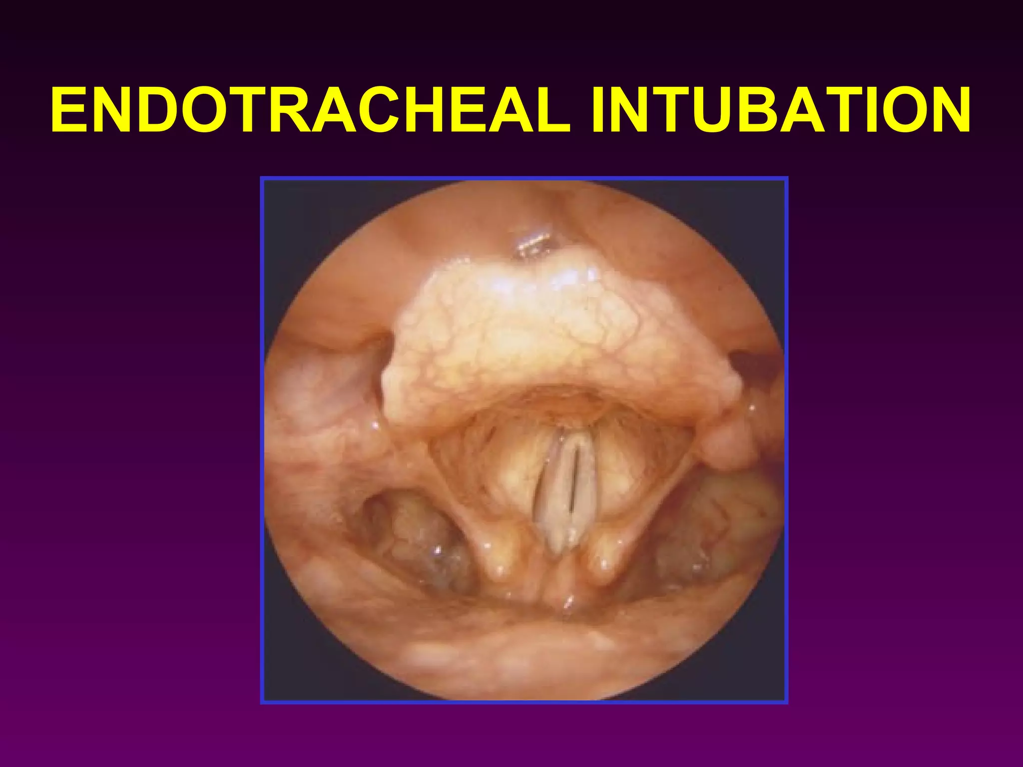 ENDOTRACHEAL INTUBATION
 