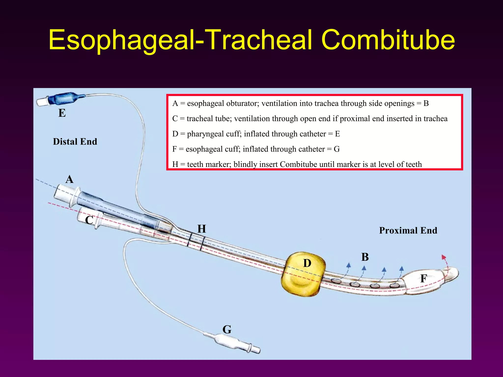 Esophageal-Tracheal Combitube

             A = esophageal obturator; ventilation into trachea through side openings = B
 E           C = tracheal tube; ventilation through open end if proximal end inserted in trachea
             D = pharyngeal cuff; inflated through catheter = E
Distal End
             F = esophageal cuff; inflated through catheter = G
             H = teeth marker; blindly insert Combitube until marker is at level of teeth
  A


       C
                    H                                                      Proximal End

                                                                      B
                                                    D
                                                                                        F



                            G
 