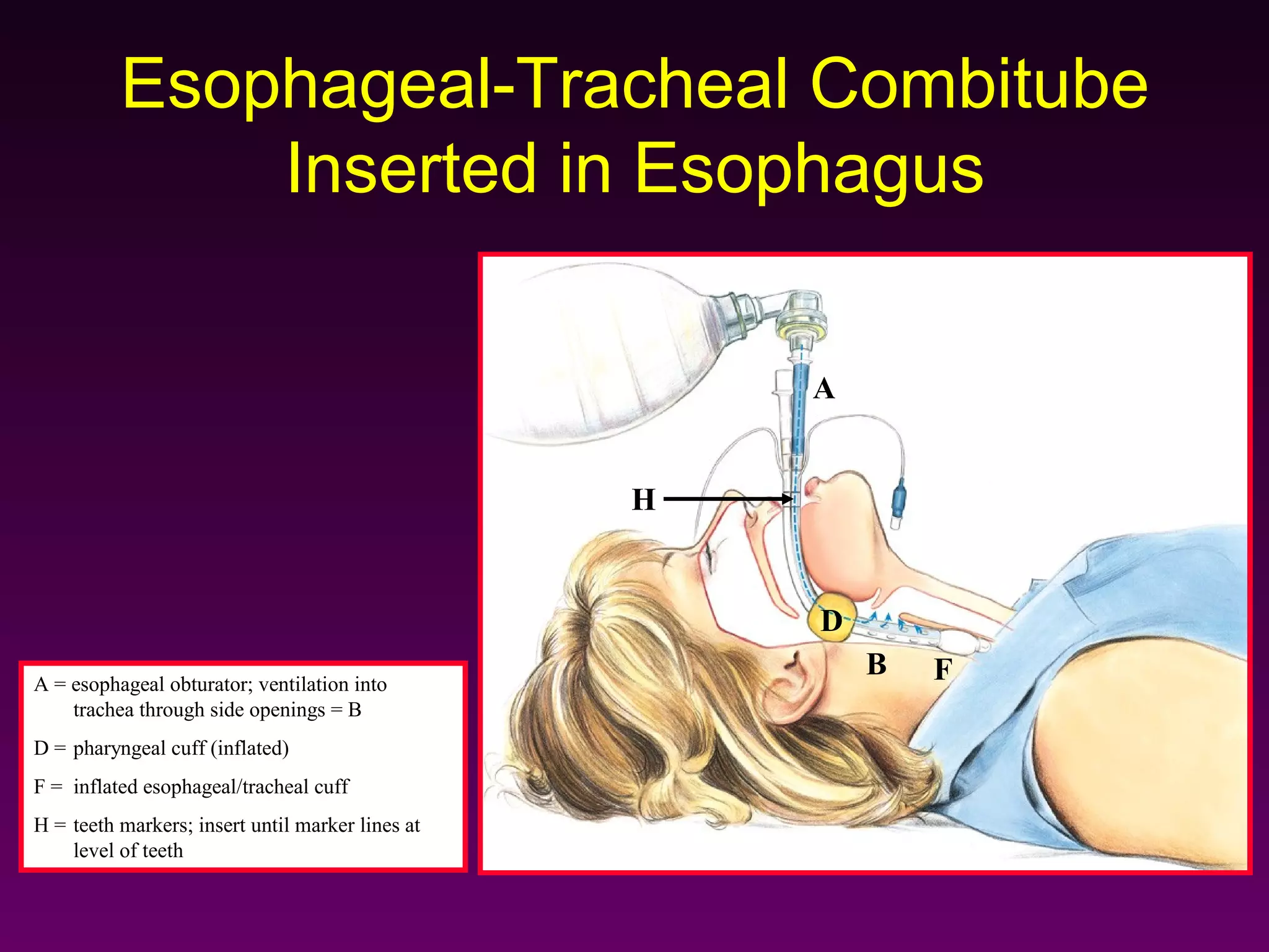 Esophageal-Tracheal Combitube
              Inserted in Esophagus

                                                      A


                                                  H


                                                      D
                                                          D
                                                          B   F
A = esophageal obturator; ventilation into
    trachea through side openings = B
D = pharyngeal cuff (inflated)
F = inflated esophageal/tracheal cuff
H = teeth markers; insert until marker lines at
    level of teeth
 