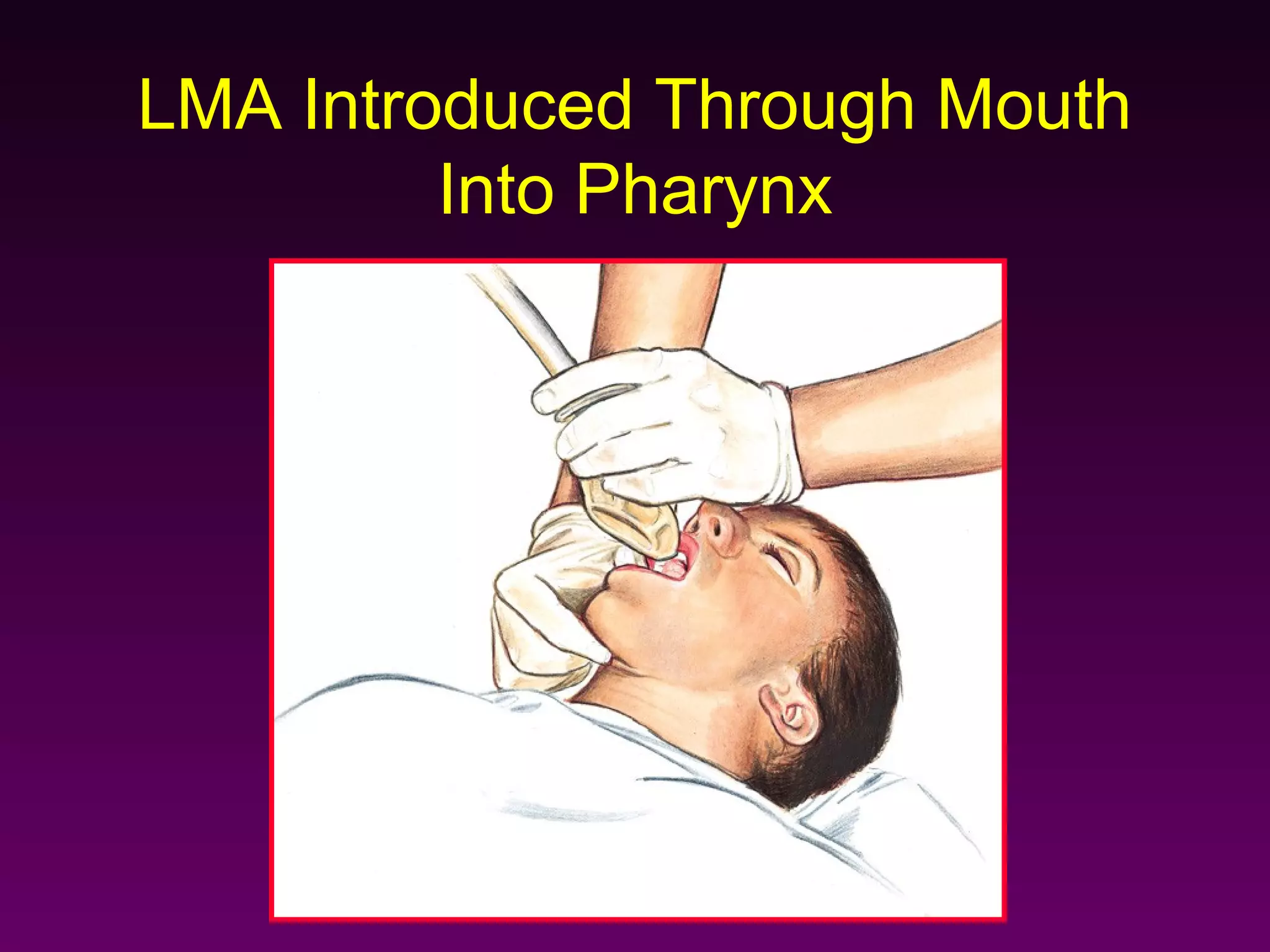 LMA Introduced Through Mouth
         Into Pharynx
 