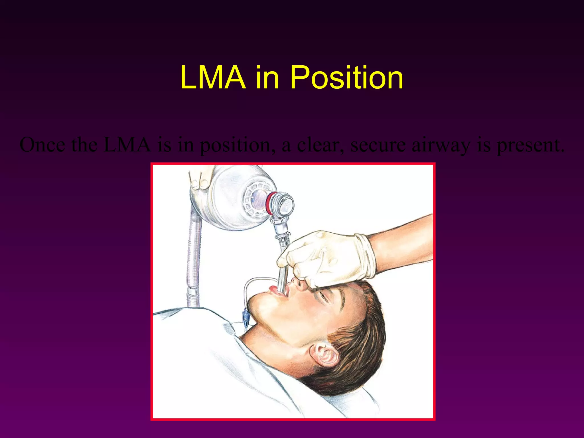 LMA in Position
Once the LMA is in position, a clear, secure airway is present.
 