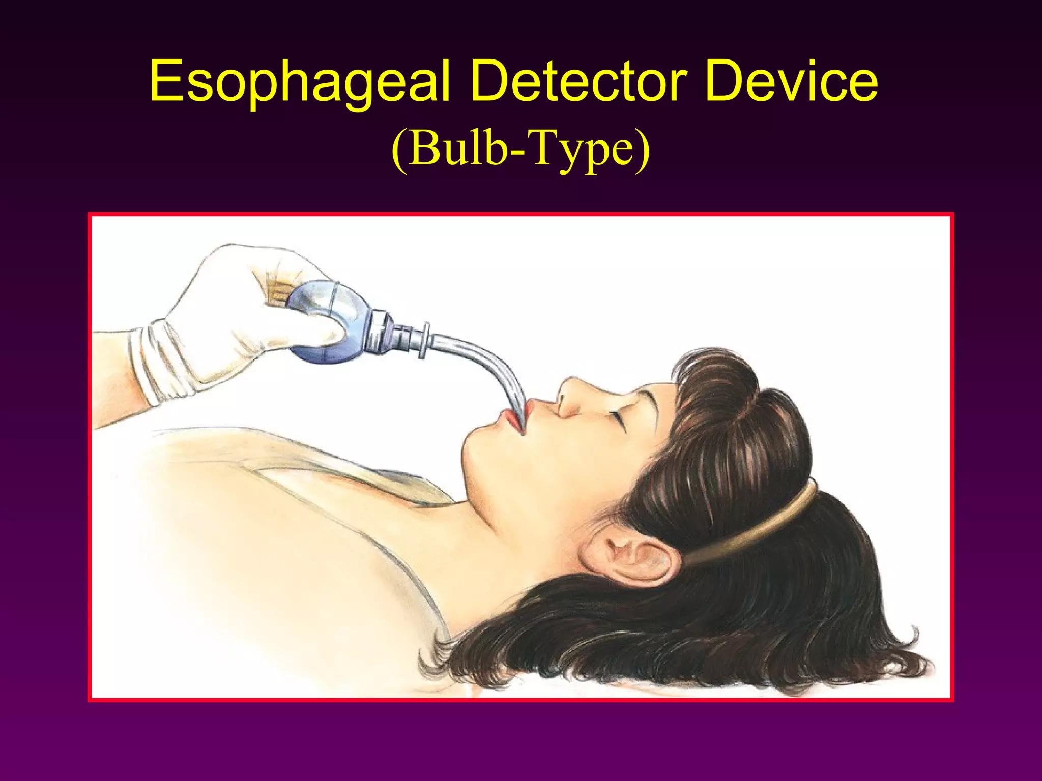 Esophageal Detector Device
        (Bulb-Type)
 