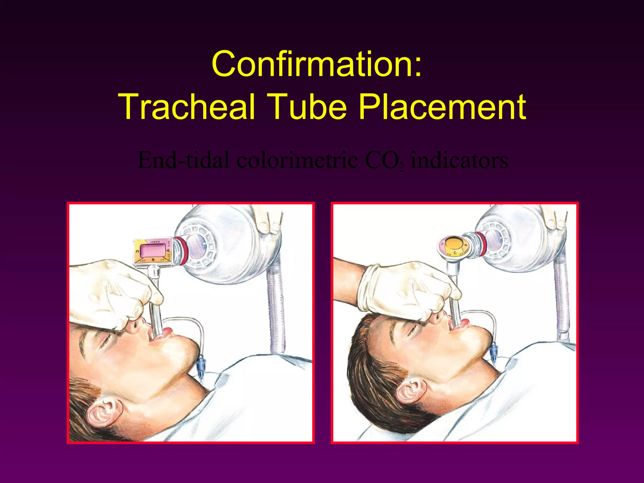 Confirmation:
Tracheal Tube Placement
 End-tidal colorimetric CO2 indicators
 