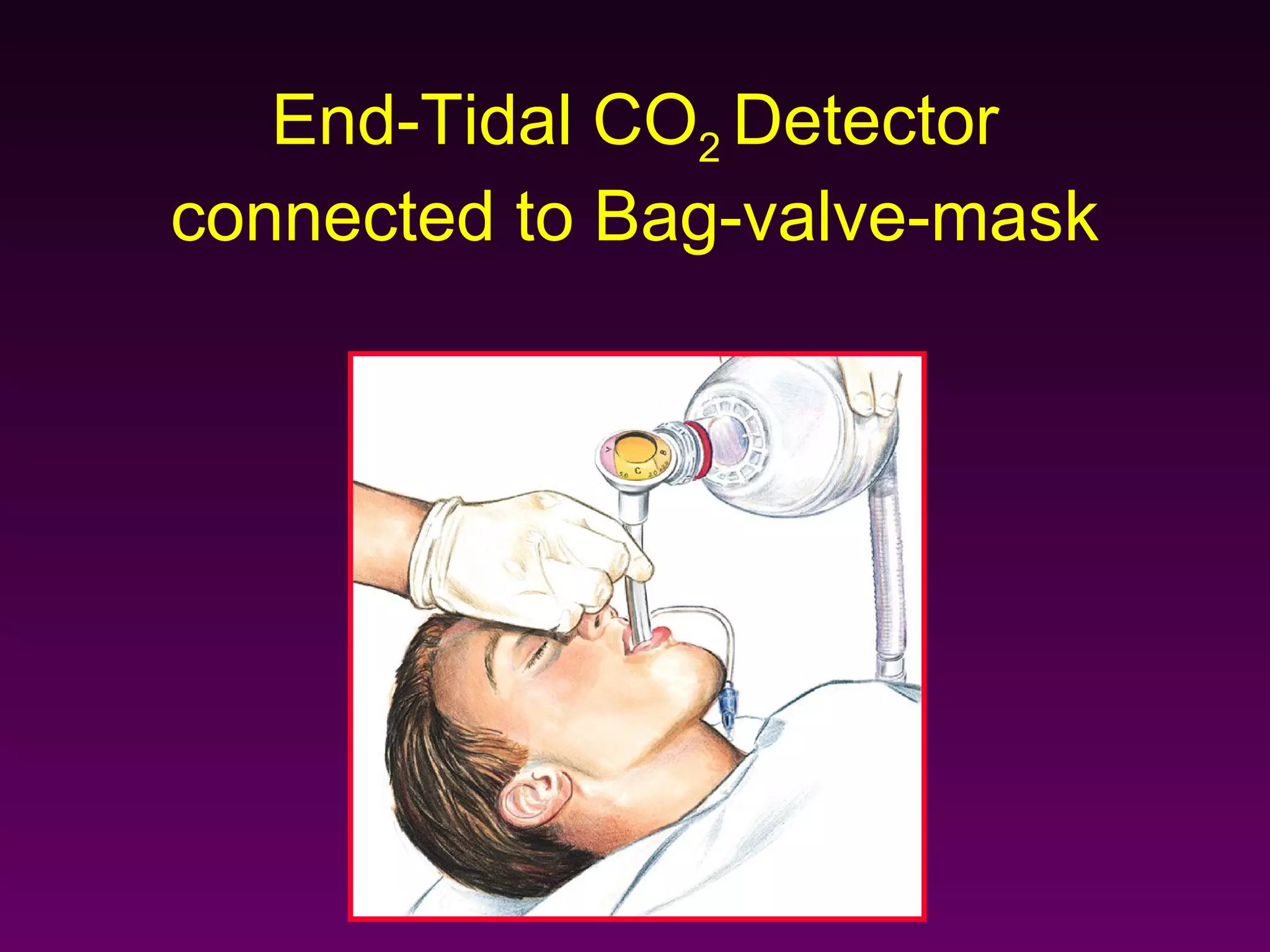 End-Tidal CO2 Detector
connected to Bag-valve-mask
 