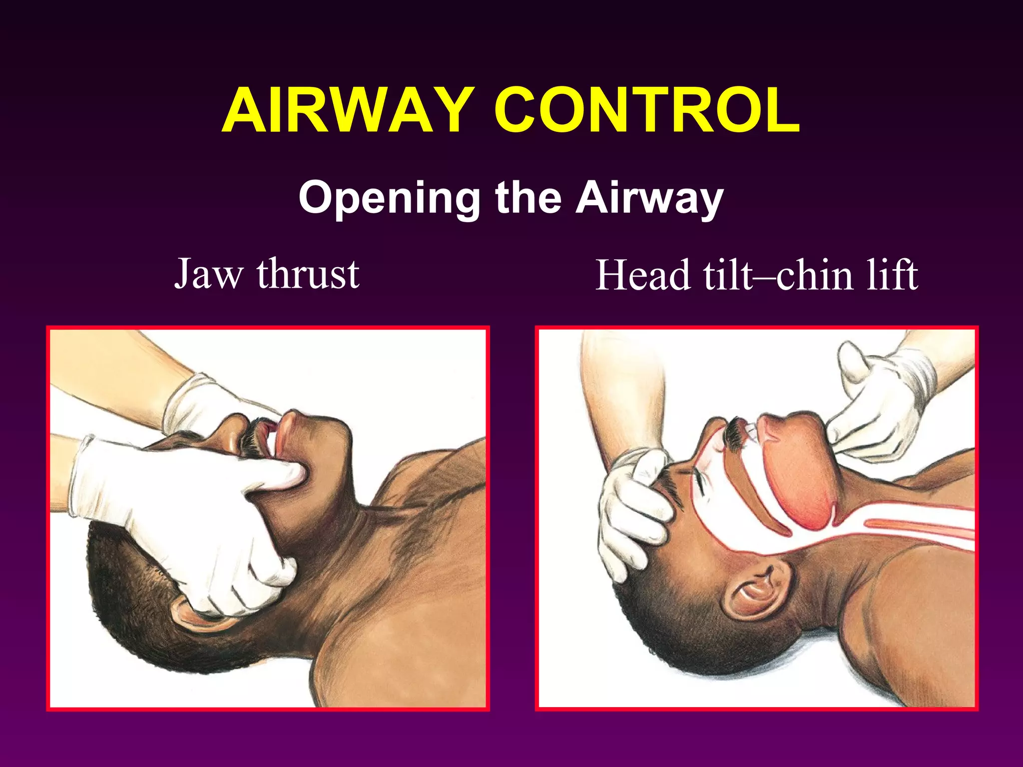 AIRWAY CONTROL
      Opening the Airway
Jaw thrust        Head tilt–chin lift
 