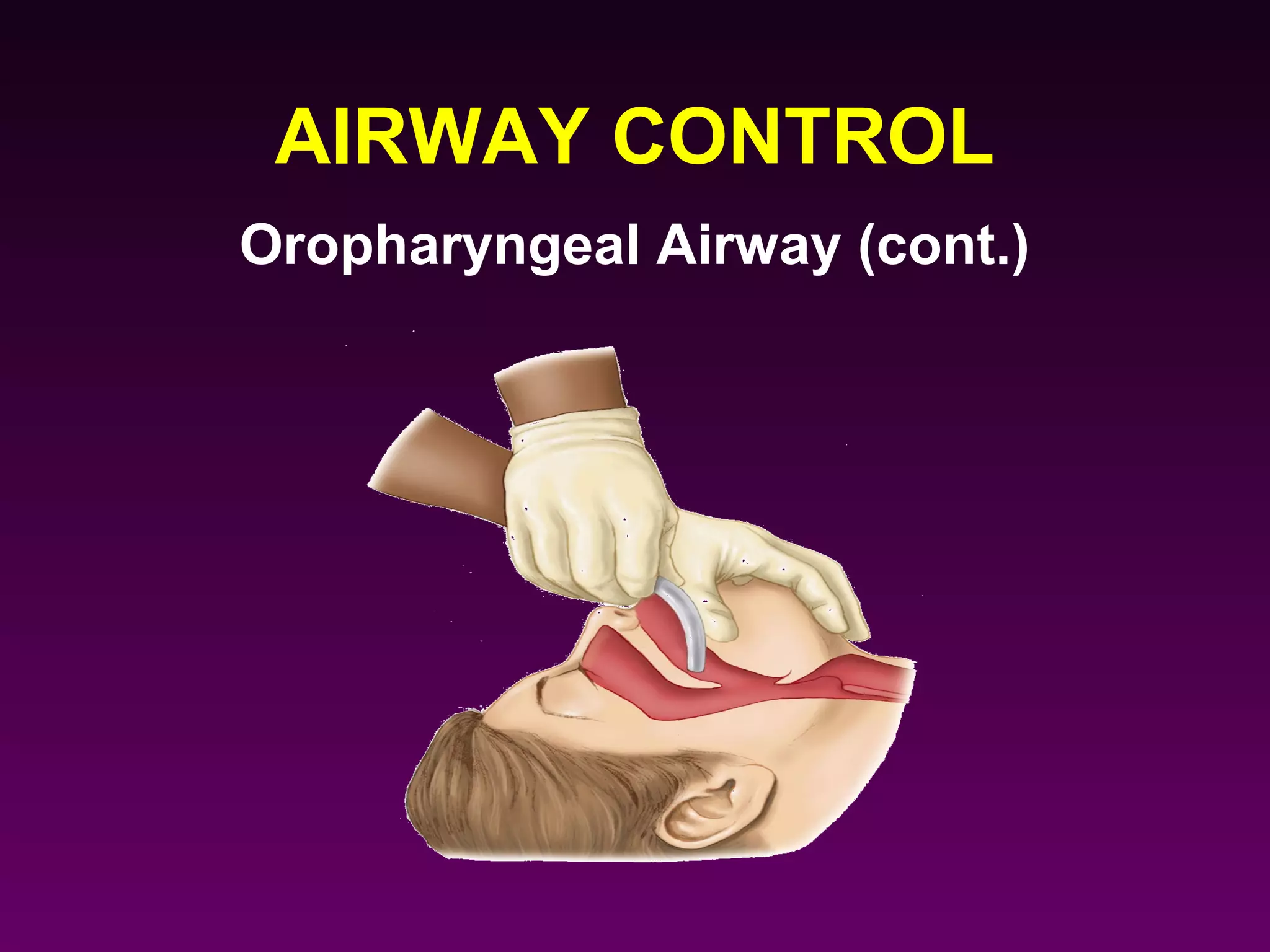 AIRWAY CONTROL
Oropharyngeal Airway (cont.)
 
