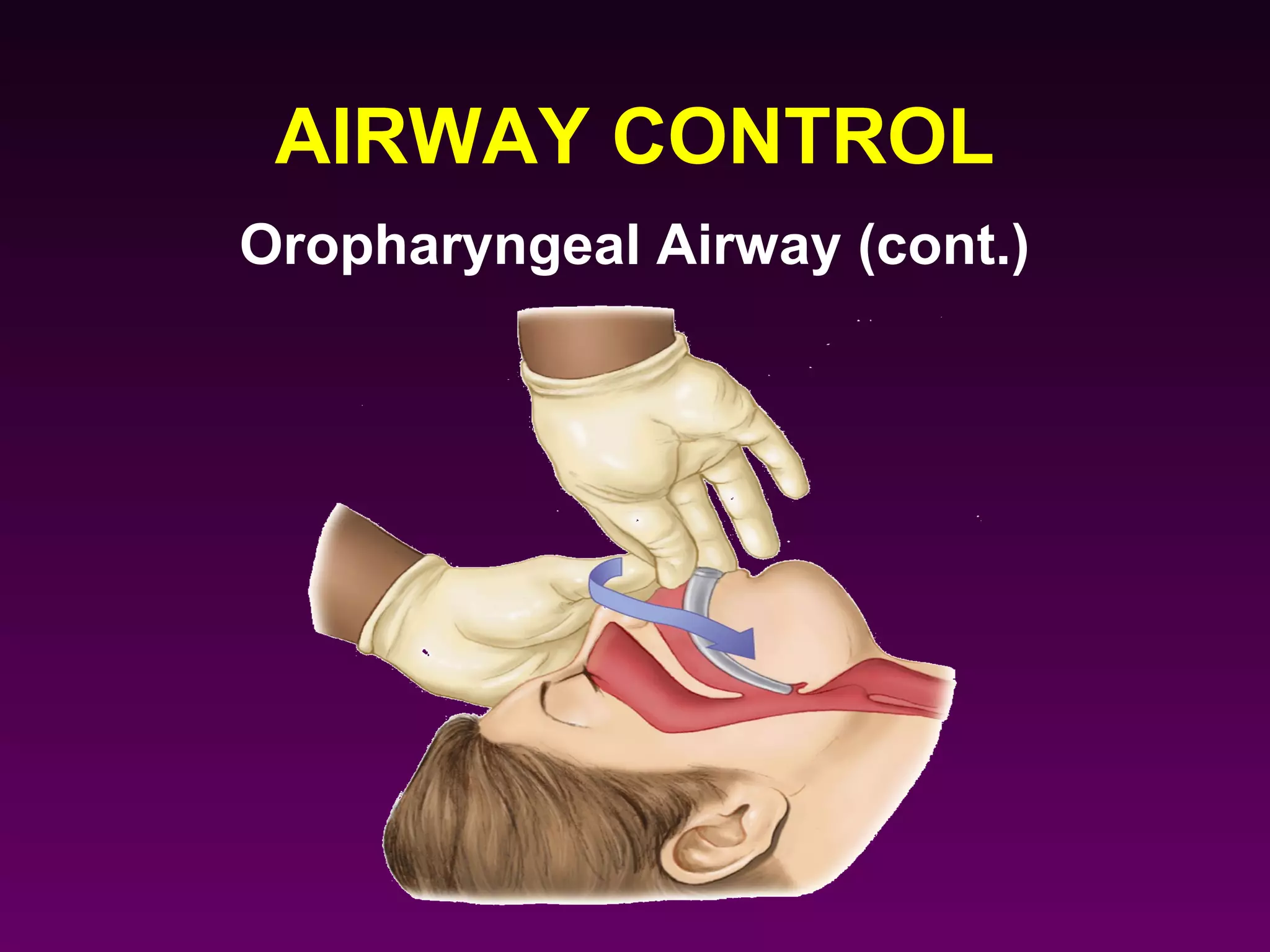 AIRWAY CONTROL
Oropharyngeal Airway (cont.)
 