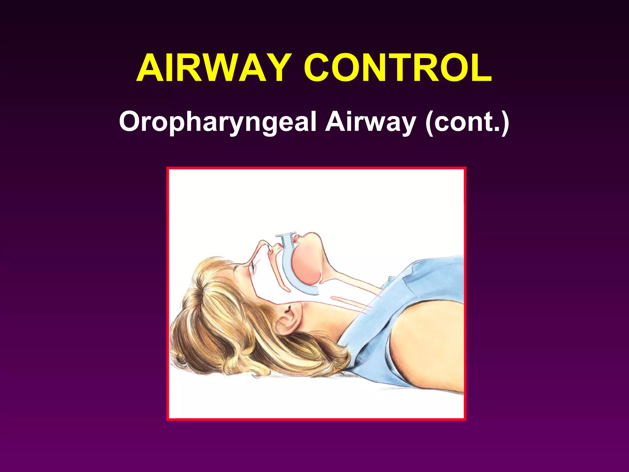 AIRWAY CONTROL
Oropharyngeal Airway (cont.)
 