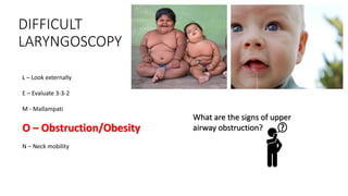 DIFFICULT
LARYNGOSCOPY
L – Look externally
E – Evaluate 3-3-2
M - Mallampati
O – Obstruction/Obesity
N – Neck mobility
What are the signs of upper
airway obstruction?
 