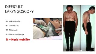 DIFFICULT
LARYNGOSCOPY
L – Look externally
E – Evaluate 3-3-2
M - Mallampati
O – Obstruction/Obesity
N – Neck mobility
 