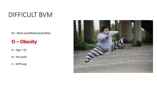 DIFFICULT BVM
M – Mask seal/Mallampati/Male
O – Obesity
A – Age > 55
N – No teeth
S – Stiff lung
 