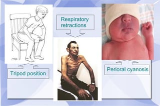 Tripod position Respiratory retractions Perioral cyanosis 