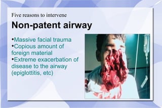 Five reasons to intervene Non-patent airway Massive facial trauma Copious amount of  foreign material Extreme exacerbation of  disease to the airway  (epiglottitis, etc) 