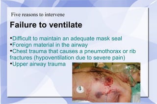 Five reasons to intervene Failure to ventilate Difficult to maintain an adequate mask seal Foreign material in the airway Chest trauma that causes a pneumothorax or rib  fractures (hypoventilation due to severe pain) Upper airway trauma 