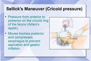 Sellick's Maneuver (Cricoid pressure) Pressure from anterior to posterior on the cricoid ring of the larynx (Adam's apple). Moves trachea posterior and compresses esophagus to prevent aspiration and gastric inflation. 