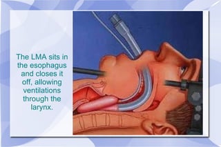 The LMA sits in the esophagus and closes it off, allowing ventilations through the larynx. 