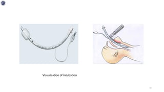 Anesthesia and Reanimation: AIRWAY and ENTUBATION.pptx