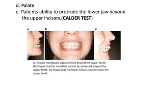 d. Palate
e. Patients ability to protrude the lower jaw beyond
the upper incisors.(CALDER TEST)
(a) Shows mandibular advancement beyond the upper teeth.
(b) Shows that the mandible cannot be advanced beyond the
upper teeth. (c) Shows that the lower incisors cannot reach the
upper teeth.
 