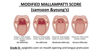 MODIFIED MALLAMPATTI SCORE
(samsoon &young’s)
Grade 0: epiglottis seen on mouth opening and tongue protrusion
 