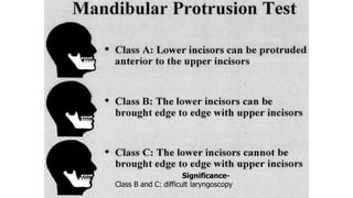 Significance-
Class B and C: difficult laryngoscopy
 