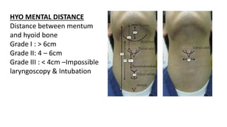 HYO MENTAL DISTANCE
Distance between mentum
and hyoid bone
Grade I : > 6cm
Grade II: 4 – 6cm
Grade III : < 4cm –Impossible
laryngoscopy & Intubation
 